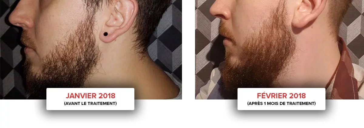 accelerateur barbe