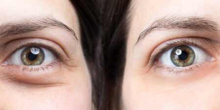 Anti-cernes pour homme, les solutions vraiment efficaces cernes sous les yeux